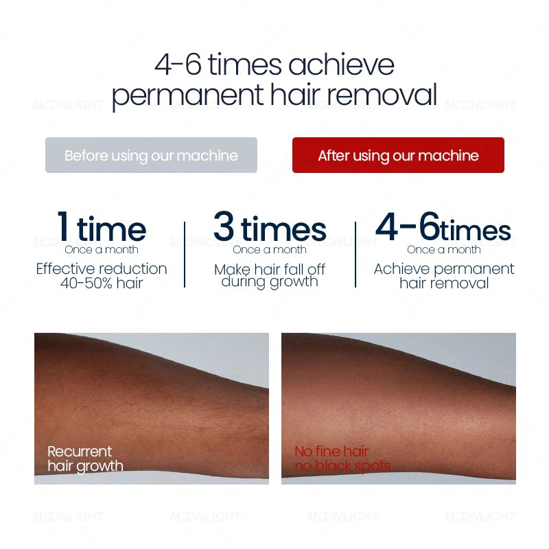 4-Wave 3000W Diode Laser Hair Removal Machine price