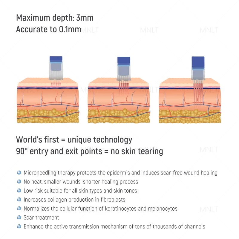 Dermapen 4: Revolutionize Your Skin Treatment