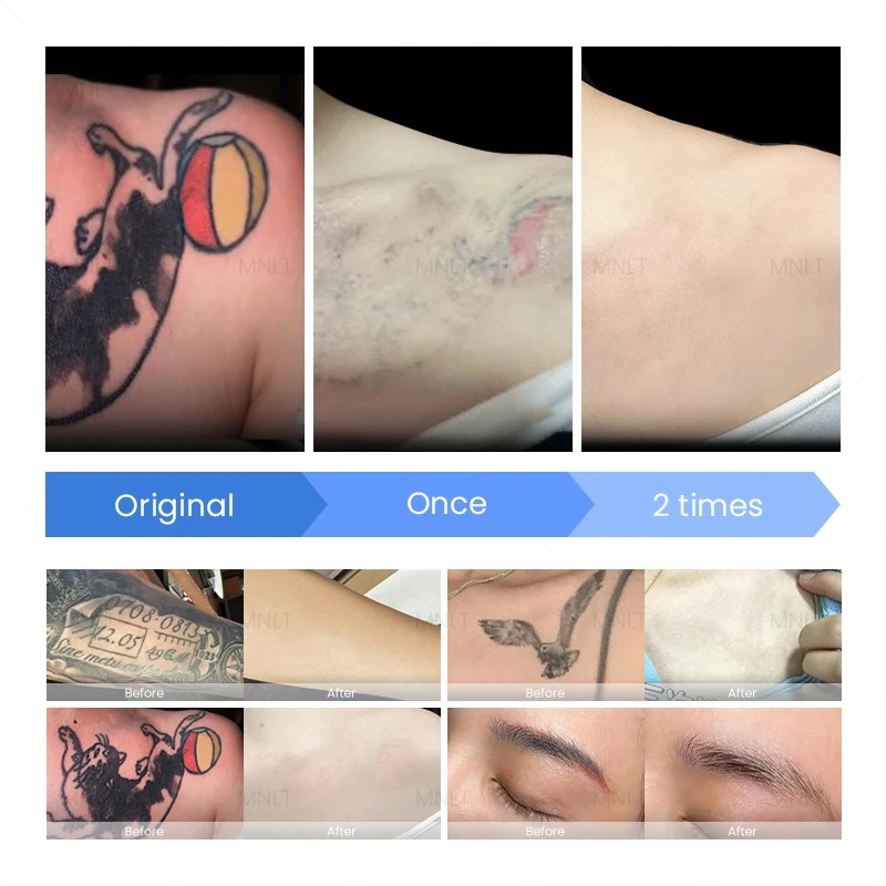 ND YAG Laser Machine – Professional Solution For Tattoo Removal & Skin Treatments best