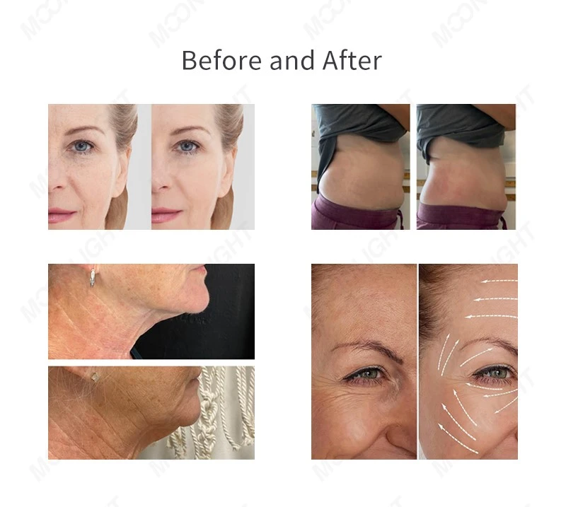 treatment effect treatment effect