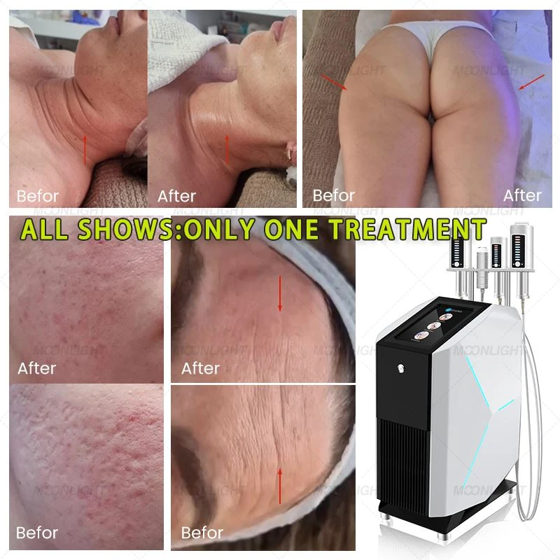 Terapia rolkowa SlimSphere